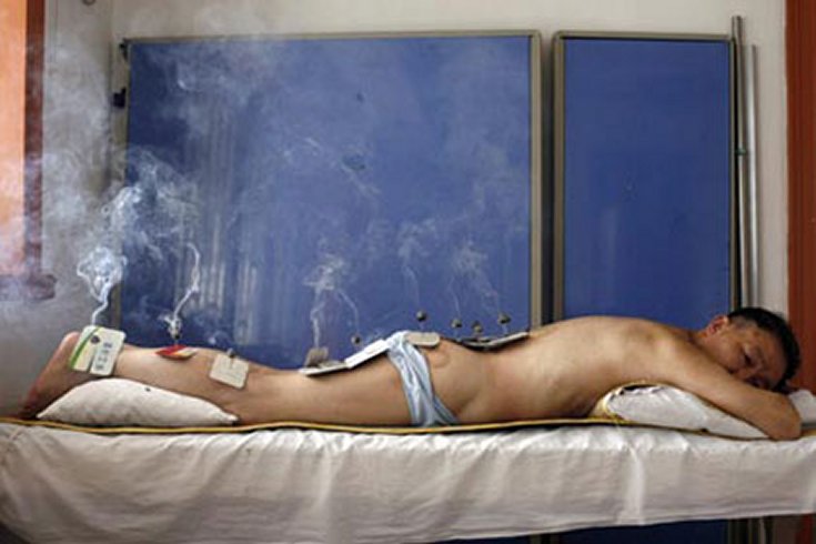 Moxibustion_Is_Hot-PatientReceivingMoxibustion